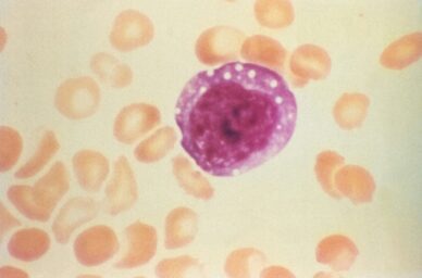 Microscopic image of an enlarged atypical lymphocyte in a patient with hantavirus pulmonary syndrome