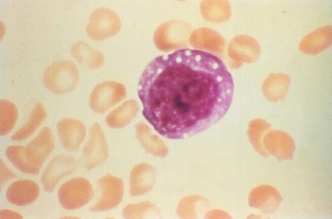 Microscopic image of an enlarged atypical lymphocyte in a patient with hantavirus pulmonary syndrome